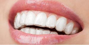 Dentist in Ashburn Virginia Invisalign