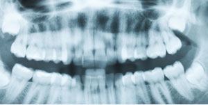 Dentist in Ashburn Virginia Tooth Extractions